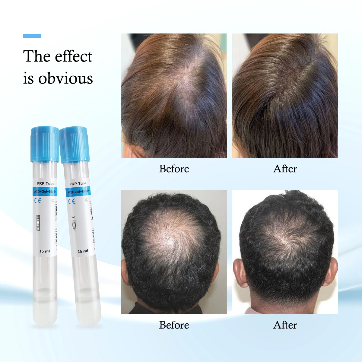 Тюбик ACD Gel Biotin PRP